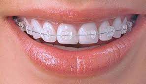 instant white teeth